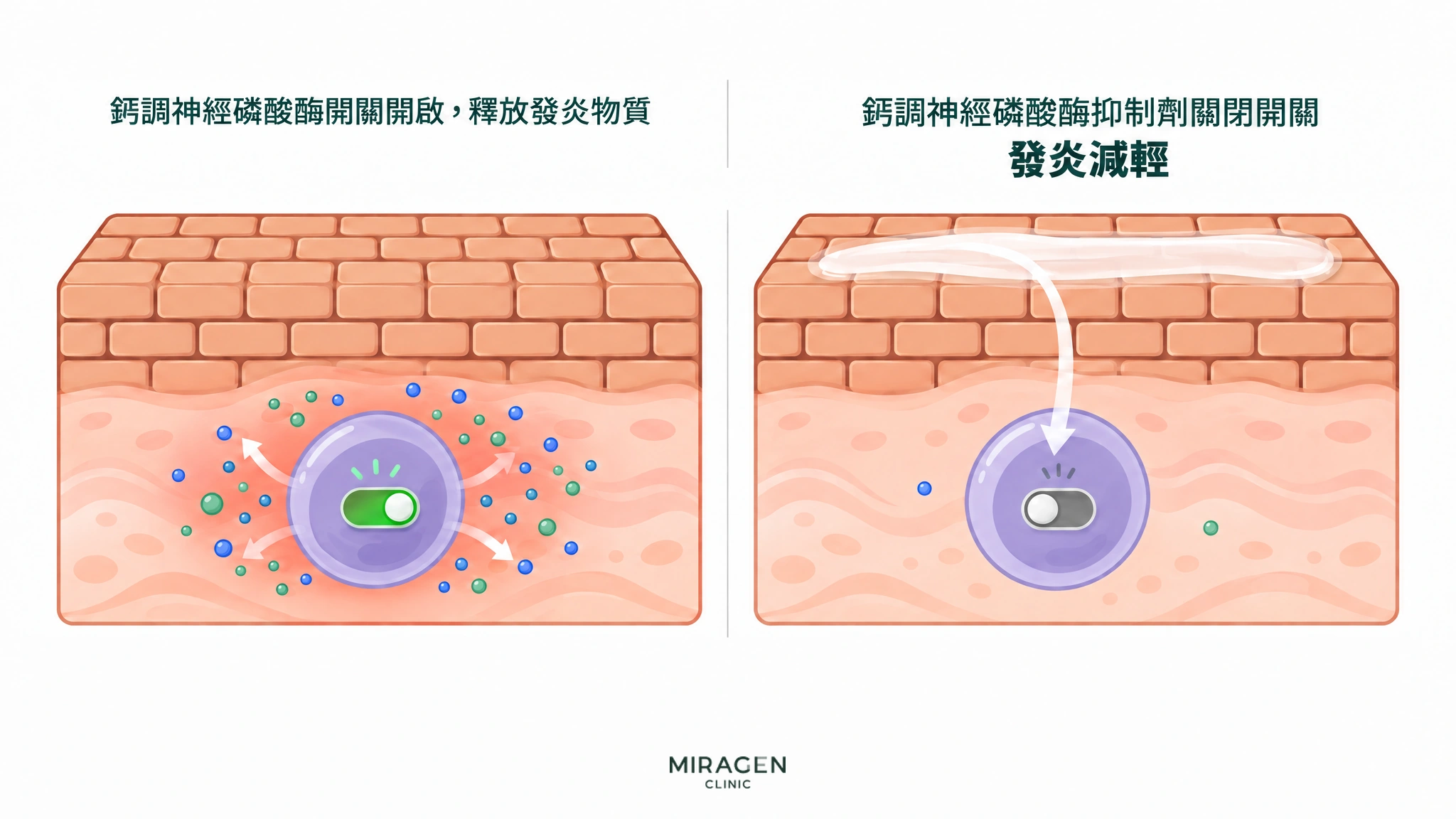 比較開啟的鈣調神經磷酸酶開關使T細胞釋放發炎物質的樣子,以及塗在皮膚上的鈣調神經磷酸酶抑制劑關閉該開關、發炎減輕的樣子