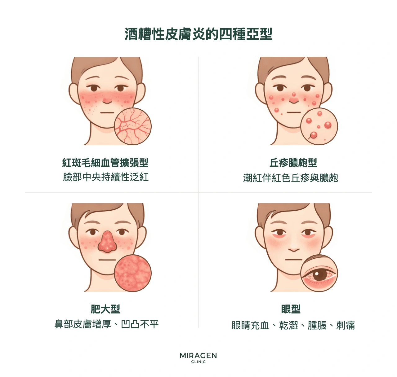 酒糟性皮膚炎的四種類型分類：紅斑毛細血管擴張型的特徵是臉部持續性泛紅，丘疹膿皰型是類似痘痘的丘疹，鼻贅型是鼻部皮膚增厚，眼型是眼睛充血與乾澀，以圖像對照比較這套分類