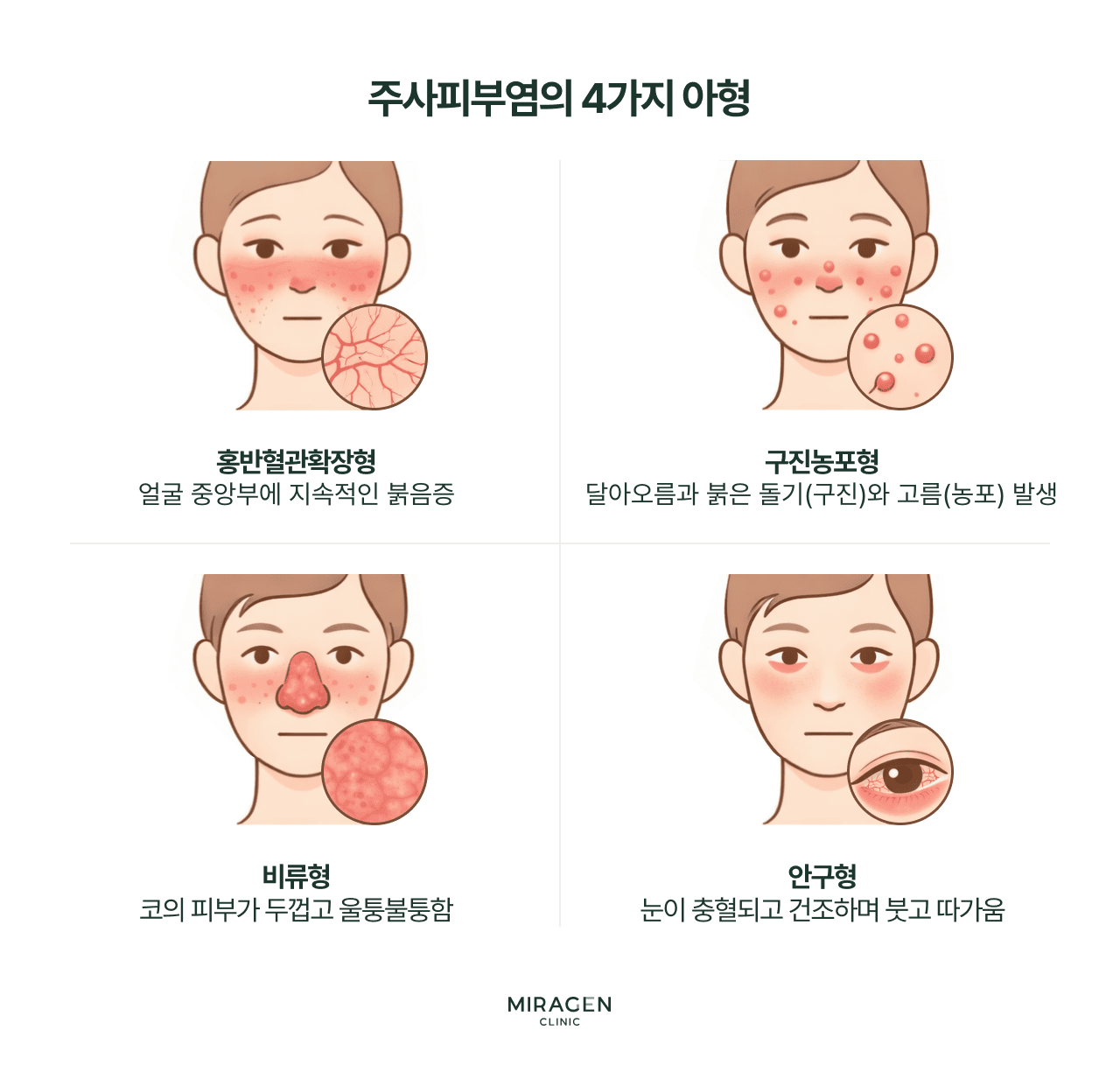 주사피부염의 네 가지 유형 분류: 홍반혈관확장형은 얼굴의 지속적인 붉음증, 구진농포형은 여드름 유사 구진, 비류형은 코 피부 비대, 안구형은 눈 충혈과 건조가 특징인 분류 체계를 시각적으로 비교합니다