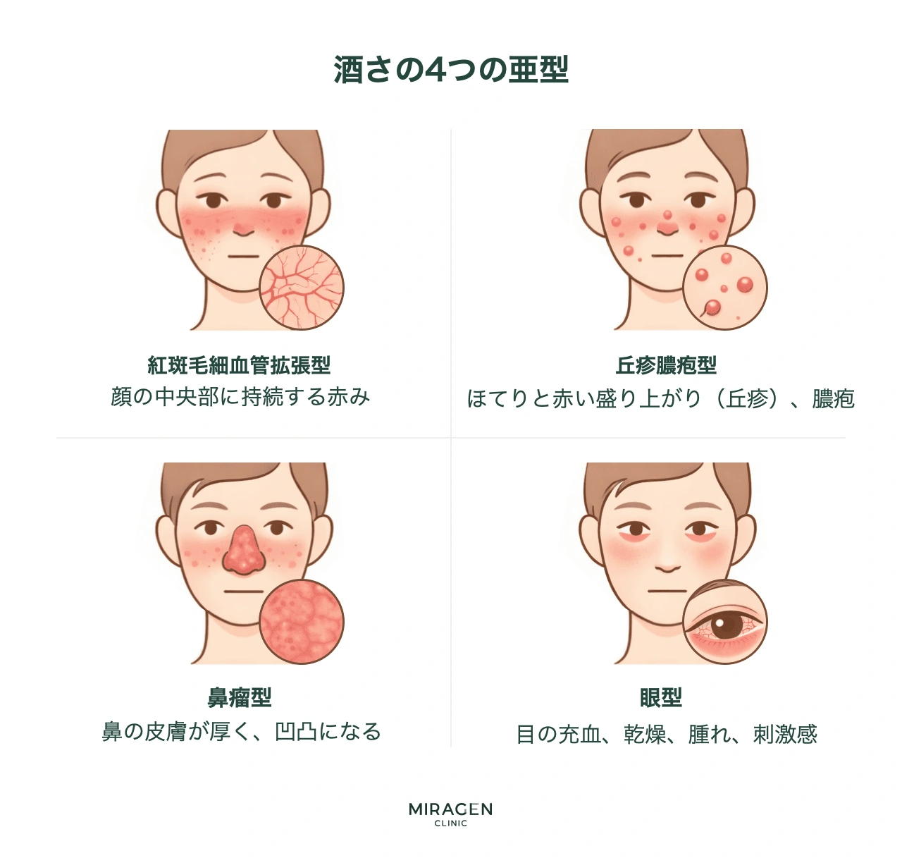 酒さの4つのタイプ分類：紅斑毛細血管拡張型は顔の持続する赤み、丘疹膿疱型はニキビに似た丘疹、鼻瘤型は鼻の皮膚の肥厚、眼型は目の充血と乾燥が特徴である分類を視覚的に比較します